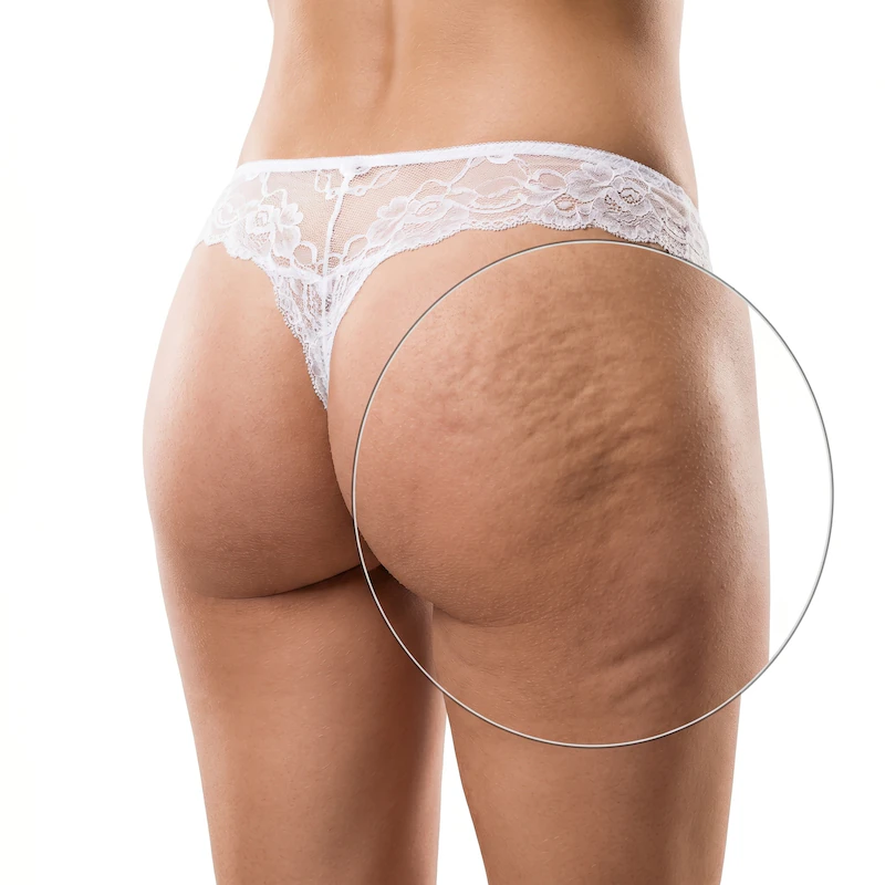 Tratamento de Celulite — Clínica Estética Vital Beauty Mogi das Cruzes