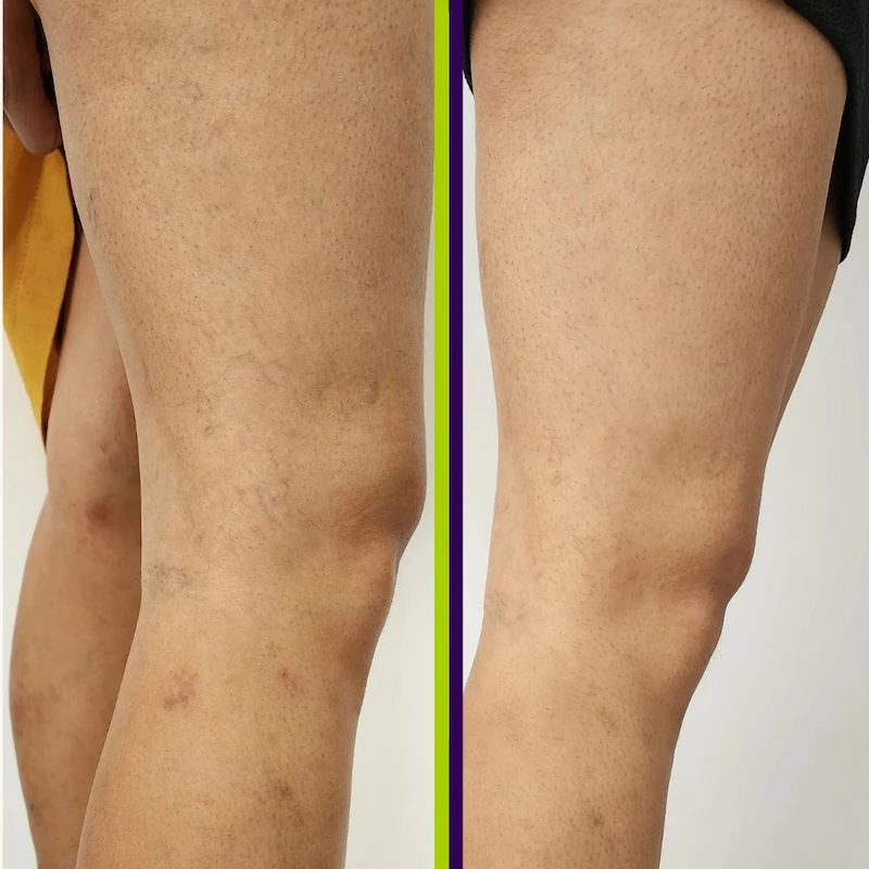 Bye Bye Vasinhos (3 Sessões)