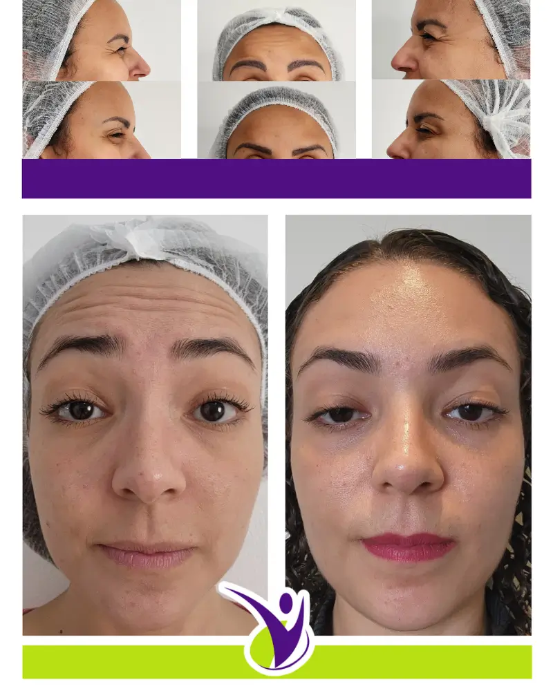 Aplicação estética facial avançada antissinais em Mogi das Cruzes – Clínica Vital Beauty