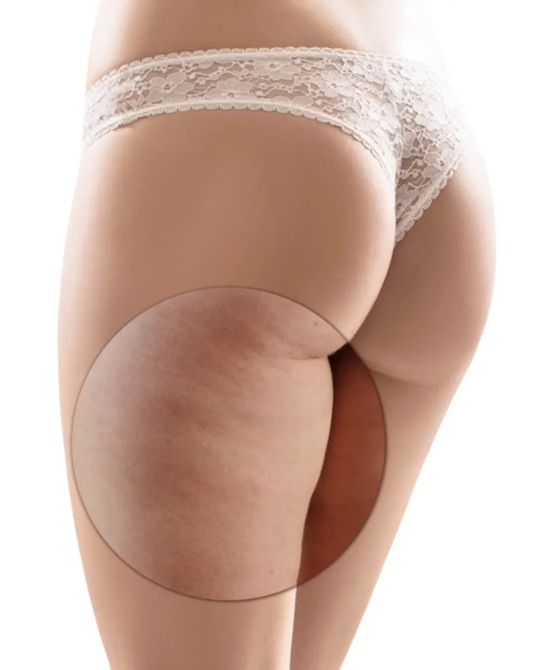 Tratamento para Celulite