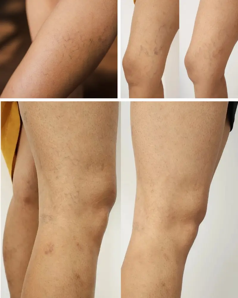 Tratamento para vasinhos nas pernas em Mogi das Cruzes – Estética Vital Beauty com resultados visíveis