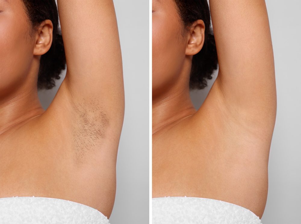 Antes e Depois Depilação a Laser Axila e Virilha