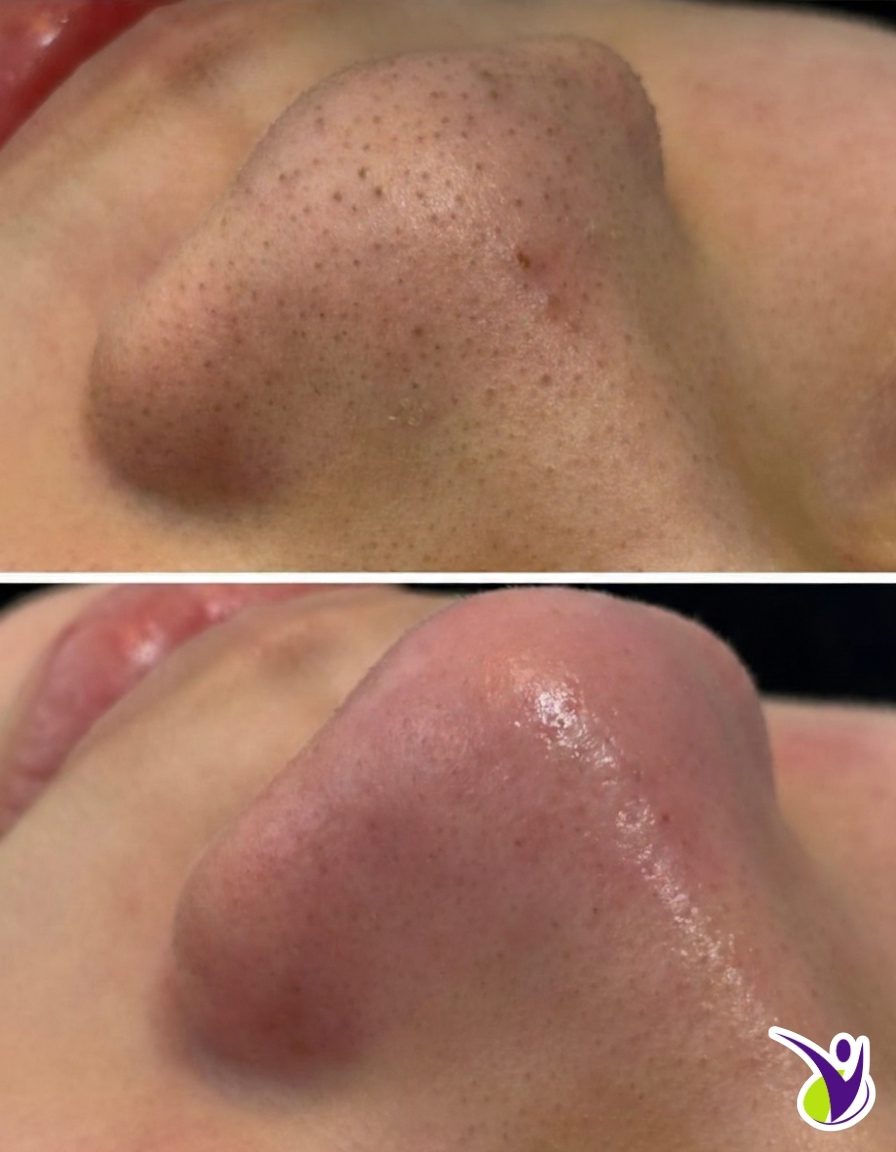 Limpeza de Pele Antes e Depois Nariz